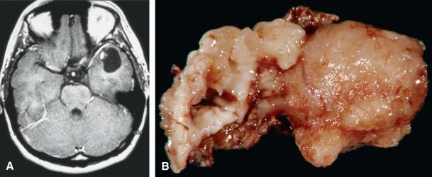 Fig. 10.1, Ganglioglioma. (A) Postcontrast axial MR image of a ganglioglioma in the left temporal lobe demonstrating the characteristic cyst and mural nodule pattern, with intense contrast enhancement of the solid component. (B) Gross specimen demonstrating the solid (right) and cystic (left) components of a ganglioglioma.