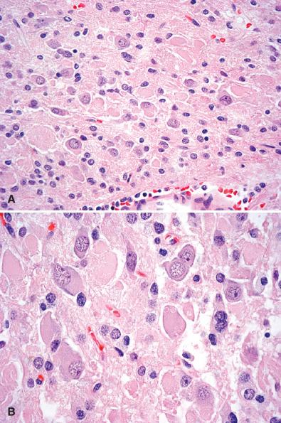 Fig. 10.2, Gangliocytoma. (A, B) Clusters of atypical, pleomorphic ganglion cells, including binucleate forms, are embedded in a haphazard manner within a delicate neuropil matrix. No definite neoplastic glial cells are present in a gangliocytoma.