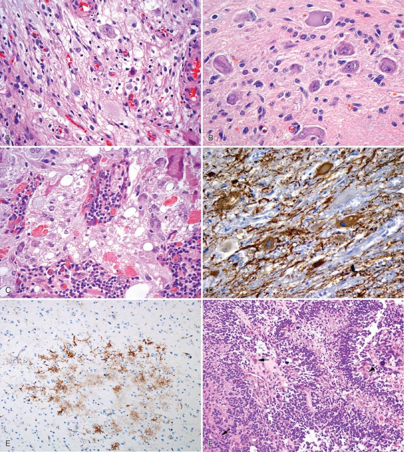 Fig. 10.3, Ganglioglioma and anaplastic ganglioglioma. (A, B) Large, atypical, and unoriented ganglion cells are seen admixed with neoplastic, mildly pleomorphic astrocytic glial element. (C) Typical features noted in gangliogliomas are lymphocytic infiltrates and eosinophilic granular bodies (EGBs). (D) Synaptophysin immunoreactivity highlights the ganglion cells of ganglioglioma, especially the cell surfaces, and also demonstrates the extensive network of neuronal processes in the tumor stroma. (E) Immunohistochemistry for CD34 shows aberrant staining of an atypical cell population in ganglioglioma. (F) Anaplastic ganglioglioma with a high-grade glial component resembling glioblastoma, including hypercellularity, nuclear aytpia, mitotic activity, palisading necrosis, and microvascular proliferation. Note that a few residual dysmorphic ganglion cells (arrows) remain even in this region of malignant transformation. (G, H) In the same tumor as illustrated in F, the precursor ganglioglioma component displayed a low MIB-1 labeling index (G), which was markedly elevated in the anaplastic region (H). (I, J) Two examples with BRAF V600E mutant protein expression, one with positivity in both neuronal and glial elements (I) and another with immunoreactivity limited to the ganglion cells (J).