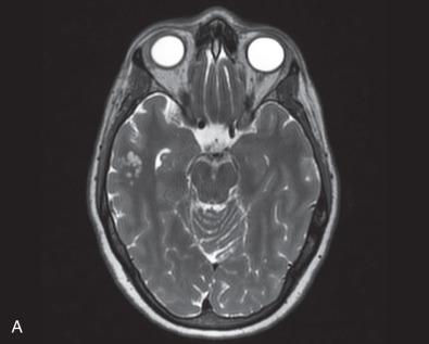 Fig. 10.4, Multinodular and vacuolating neuronal tumor of the cerebrum (MVNT). (A) Small nodules with no associated mass effect are seen in the right temporal lobe on T2-weighted MR imaging. (B) Histologically, the nodules feature vacuolated neuropil, including the cytoplasm of mildly dysmporhic neuronal cells. (C) In contrast to the intense NeuN positivity of normal cortical neurons (left side), those within the lesion (right side) are negative. (D) Also differing from normal cortical neurons, those of MVNT are often strongly OLIG2 positive.