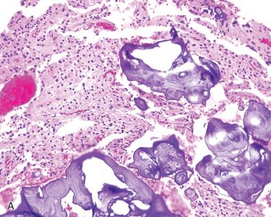 Fig. 10.5, Polymorphous low-grade neuroepithelial tumor of the young (PLNTY). (A) Typical features include heavy calcification and a predominance of oligodendroglioma-like tumor cells. (B) Occasional cells show marked atypia and/or astrocytoma-like cytology, but mature ganglion cells are not seen. (C, D) Tumor cells are strongly and diffusely positive for CD34 (C) and OLIG2 (D).