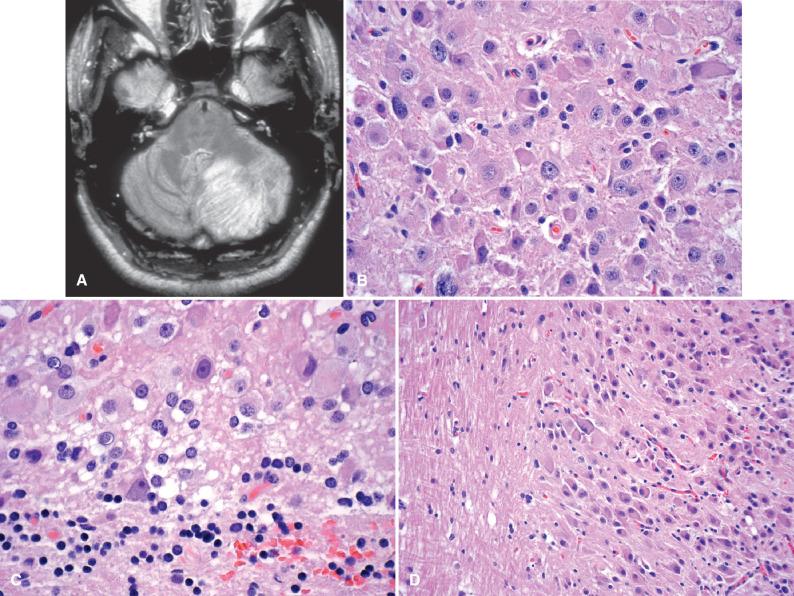 Fig. 10.7, Dysplastic gangliocytoma of the cerebellum (Lhermitte-Duclos disease). (A) Axial MRI (FLAIR) demonstrating unilateral expansion of the left cerebellar hemisphere and a ribbon-like pattern of alternating high and low signal intensities. (B) Atypical, hypertrophic ganglion cells dominate the histologic picture of these neoplasms. (C) Atypical ganglion cells blend in with residual granular cells of the internal granular cell layer. (D) The dysplastic ganglion cells present in these lesions have morphologic similarity to other forms of gangliocytomas. (E) Immunohistochemistry for synaptophysin highlights atypical ganglion cell bodies and processes. (F) GFAP highlights reactive astrocytes in between the dysplastic ganglion cells. (G) Chromogranin staining is less prominent and localized to the cytoplasm. (H) A NeuN stain highlights both the residual internal granular cell neurons and the dysmorphic ganglion cells (inset), suggesting that they arise from that layer given that Purkinje cells are normally negative for this marker.