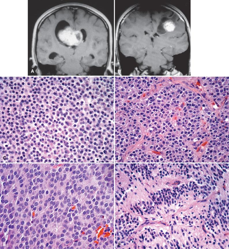 Fig. 10.8, Neurocytic neoplasms. (A) Coronal, postcontrast MRI of a central neurocytoma demonstrating its typical location in the midline, between the lateral ventricles near the foramen of Monro. (B) Coronal, postcontrast MRI of an extraventricular neurocytoma showing a cerebral hemispheric, well-circmumscribed, solid and cystic mass involving the left parietal lobe. (C, D) Typical histologic appearance of neurocytomas, with densely packed small to midsize, round, bland tumor cells with lightly eosinophilic cytoplasm, growing either as sheets or in small clusters. (E) Neurocytic rosettes and a delicate neuropil background are often noted. (F) Ribbon-like growth pattern. (G) Tumor cells with clear cytoplasm have features similar to oligodendroglioma. (H) Linear growth pattern. (I) Ganglionic differentiation is more common in extraventricular neurocytomas and is rare in central neurocytoma. (J) Atypical neurocytomas are highly cellular and show cytologic atypia and mitotic activity. The example here shows microvascular hyperplasia. (K) Coagulative necrosis is a feature of atypical neurocytoma. (L) Extraventricular neurocytomas are typically well delineated from surrounding brain. (M) Neurocytomas are strongly and diffusely positive for synaptophysin by immunohistochemistry. (N) The GFAP staining seen in most central neurocytomas is limited to entrapped astrocytes.