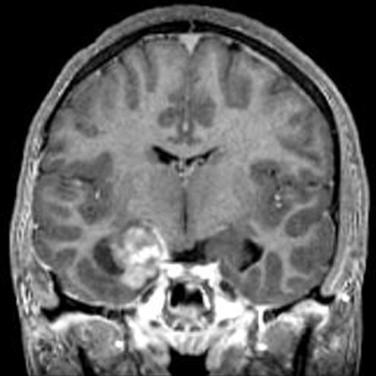 Fig 1, Ganglioglioma. This T1-weighted MRI shows an enhancing mass of the left mesial temporal lobe, a typical location for ganglioglioma.