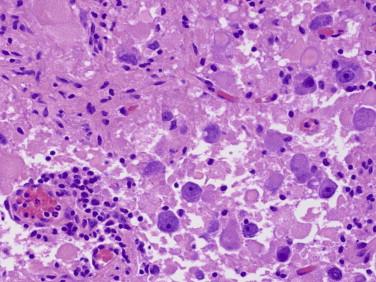 Fig 2, Ganglioglioma. The image shows a disorganized collection of several basophilic ganglion cells with vesicular nuclei and prominent nucleoli, an eosinophilic glial background, and focal perivascular inflammation.