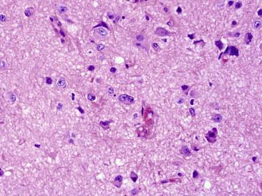 Fig 3, Ganglioglioma. Binucleated ganglion cells (like the one in the middle of the field ) are sometimes found but not required for the diagnosis.