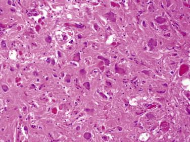 Fig 4, Ganglioglioma. Brightly eosinophilic granular bodies are characteristic.