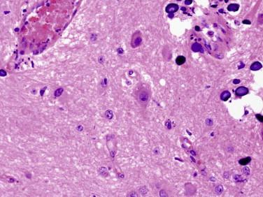 Fig 5, Ganglioglioma. Ganglion cells may show degenerative changes like the granulovacuolar change in this neuron ( center ). Microcalcifications ( left ) are also commonly found.