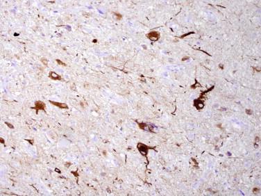 Fig 6, Ganglioglioma. Ganglion cells are strongly immunoreactive for neurofilament protein as shown here.