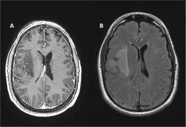 Fig. 23.2, Low-grade glioma. (A) Post-gadolinium T1-weighted image showing a hypointense mass within the right frontal lobe without significant enhancement. (B) Fluid attenuation inversion recovery (FLAIR) image showing a hyperintense mass within the right frontal lobe with mass effect.