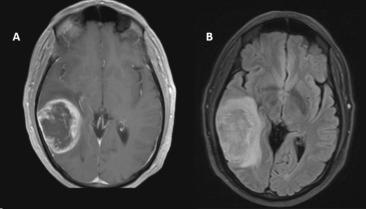 Fig. 23.3, Glioblastoma. (A) Post-gadolinium T1-weighted image showing an enhancing mass with irregular border and necrotic center within the right temporal lobe. (B) Fluid attenuation inversion recovery (FLAIR) image showing a hyperintense mass within the right temporal lobe with mass effect and vasogenic edema.