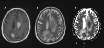 Fig. 23.4, Primary central nervous system lymphoma. (A) Post-gadolinium T1-weighted image showing diffusely enhancing masses without necrosis. (B) T2-weighted image showing a hypointense mass with surrounding vasogenic edema. (C) Apparent diffusion coefficient image showing hypointensity of the lesions, which is a sign of water diffusion restriction.