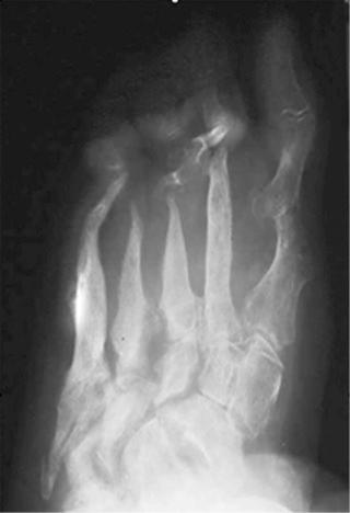 FIGURE 62–2, A middle-aged woman with Hansen disease. Oblique radiograph of the left foot demonstrates atrophic pattern of neuroarthropathy, with tapering of the metatarsals. This resembles the osseous atrophy seen in frostbite.