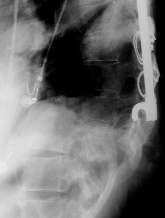 eFIGURE 62–1, Vertebral Charcot joint with fracture and frank vertebral dislocation, just caudal to the level of stabilization hardware.