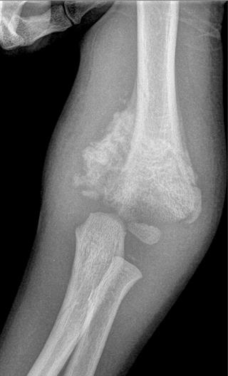 FIGURE 62–3, Congenital insensitivity to pain. Anteroposterior radiograph shows comminuted fracture of the distal humerus with fragmentation and exuberant callus formation. The known context of congenital insensitivity to pain militates against a diagnosis of tumor.