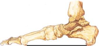 FIGURE 62–4, The weight-bearing line is drawn on a standing lateral view of the foot between the plantar aspect of the calcaneus and the sesamoid bones. Any bone extending below this line in the setting of arch collapse comprises a rocker exostosis.