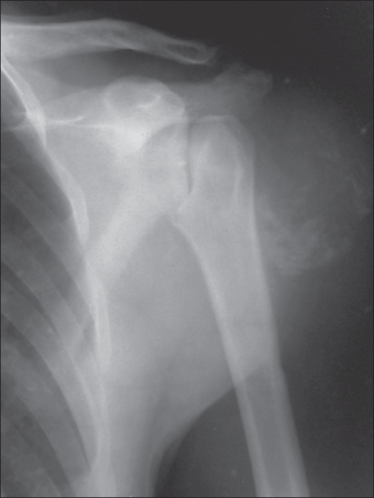 Fig. 207.1, Syringomyelia with neuropathic disease of the shoulder. Atrophic changes and soft tissue calcification are seen.