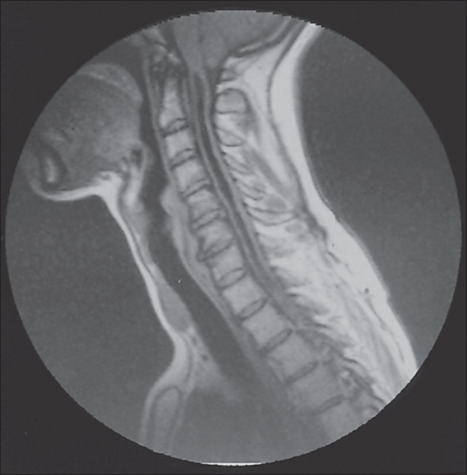 Fig. 207.3, Magnetic resonance image of the cervical spine in a patient with syringomyelia, showing the fluid-filled syrinx in the center of the spinal cord.