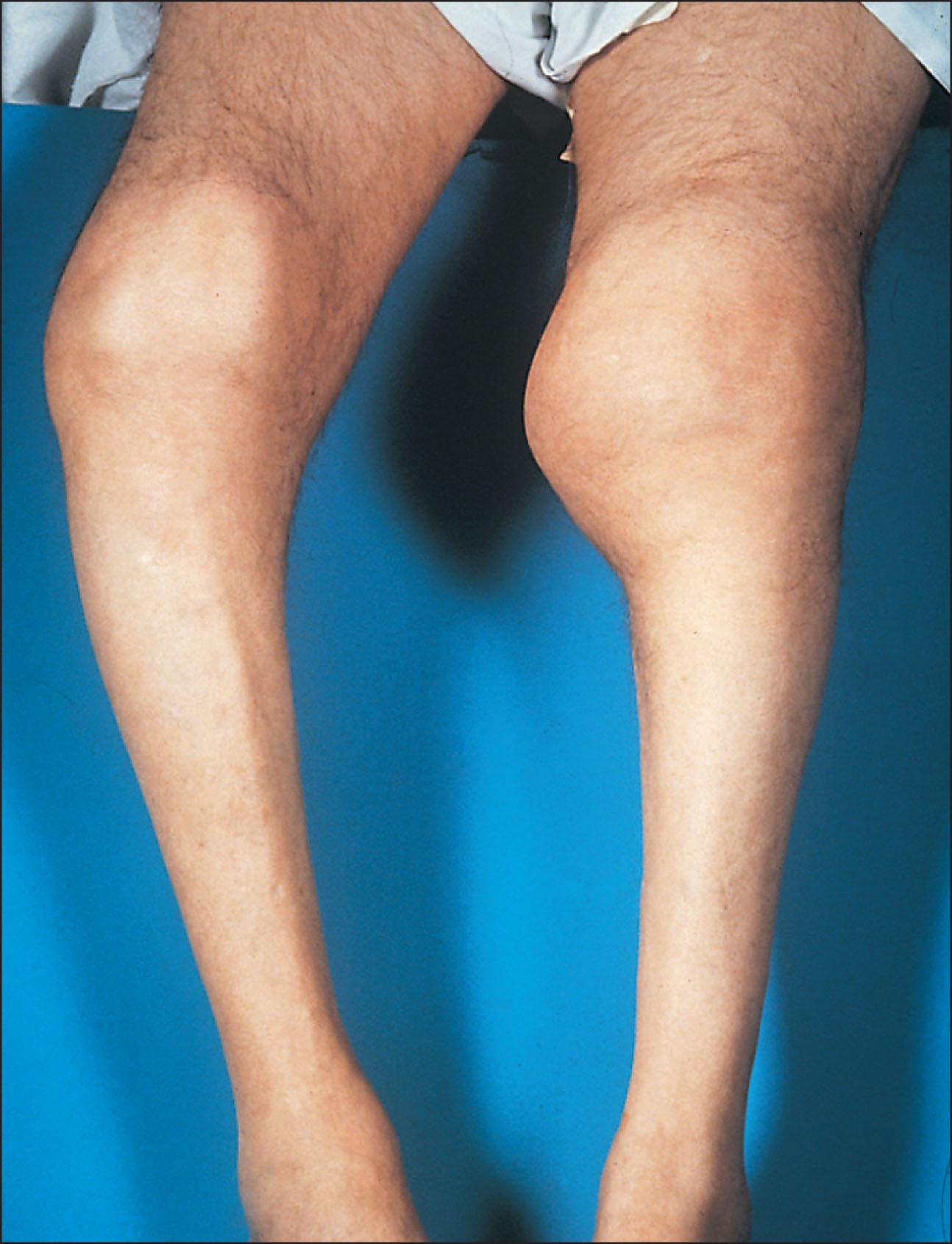 Fig. 207.4, Syphilitic Charcot knee joints showing gross destructive changes.