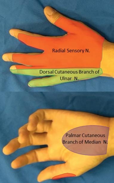 Fig. 75.1, Critical sensory nerve distributions of the arm: Numbness in the palmar cutaneous distribution of the median nerve suggests pathology proximal to the carpal tunnel. Likewise, sensory paresthesias of the dorsal cutaneous branch of the ulnar nerve indicate pathology proximal to Guyon canal. Pain or numbness in the distribution of the radial sensory nerve in absence of motor symptoms can indicate compression where the nerve becomes superficial between the extensor carpi radialis longus and brachioradialis.