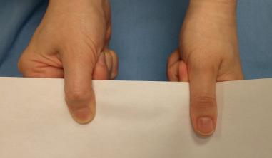 Fig. 75.3, A positive Froment sign shows flexor pollicis longus flexion in order to pinch and hold the paper between the thumb and clenched fist secondary to denervation of the ulnar innervated adductor pollicis. The right hand has a proximal ulnar nerve compression.