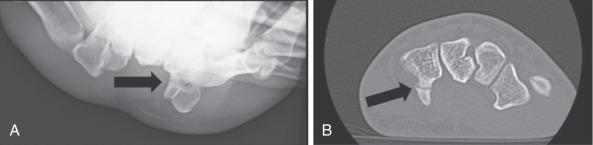 Fig. 75.4, Hook of hamate fractures may be difficult to visualize on x-ray without a special view, such as the carpal tunnel view shown here (A). Although computed tomography is still considered by most to be the “gold standard” for evaluating the hook of the hamate, when such a fracture is clinically suspected, magnetic resonance imaging can provide excellent visualization as well (B).