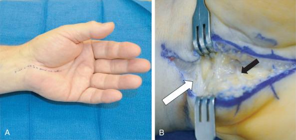 Fig. 75.5, Carpal tunnel and Guyon release: (A) The typical incision planned for carpal tunnel and Guyon canal release, just ulnar to the thenar crease. (B) The black arrow indicates an ulnar sensory branch that should be protected in the dissection. Thickened and compressive antebrachial fascia is indicated by the white arrow .