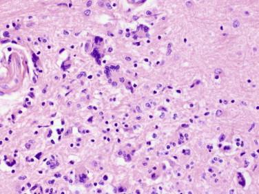 Fig 1, Giant cell (HIV) encephalitis. A loosely formed perivascular microglial nodule contains characteristic multinucleated giant cells.