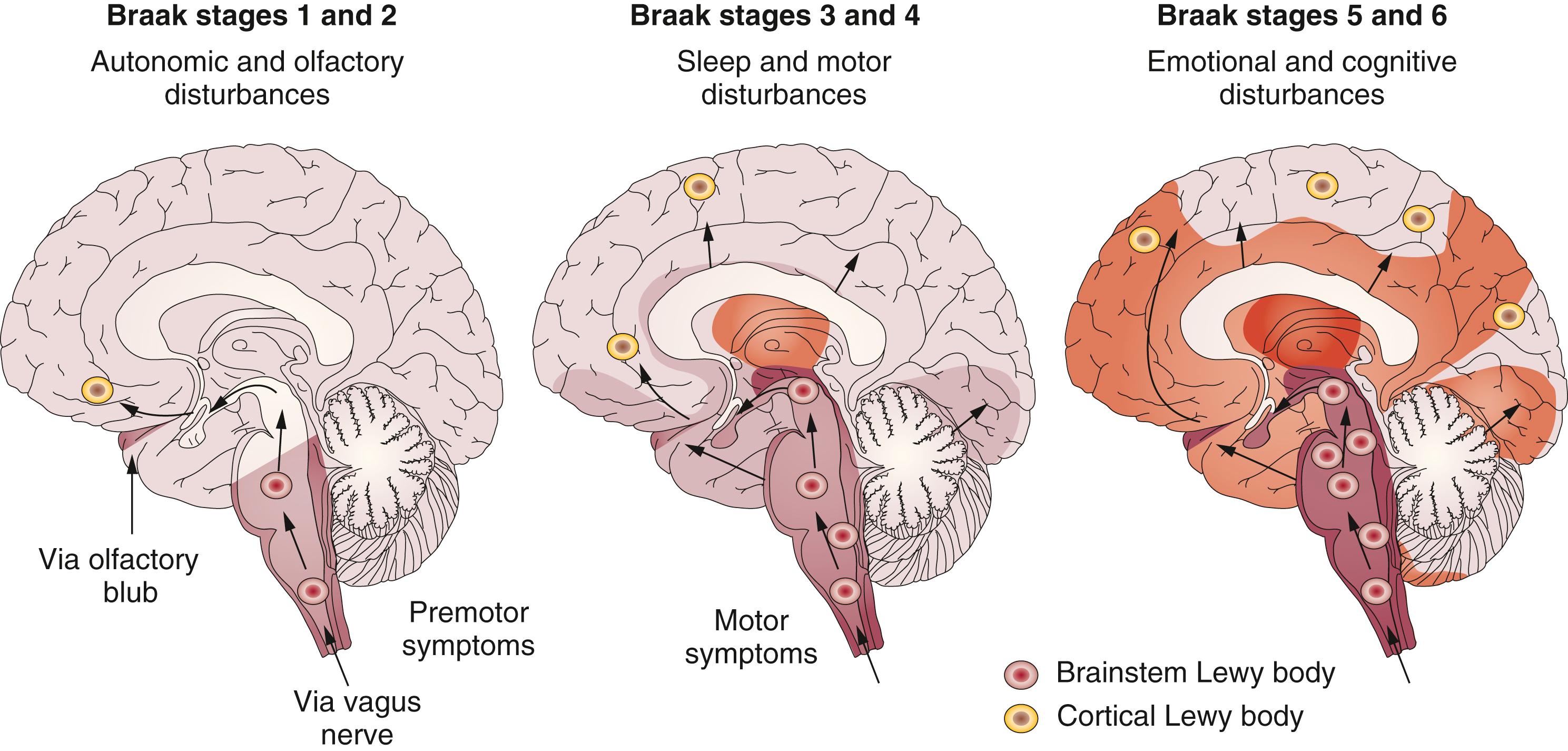 Figure 104.2, Stylized representation of the Braak staging of Lewy body pathology showing initiation sites in the medulla oblongata and olfactory bulb, progressing to the midbrain and finally to cortical regions.