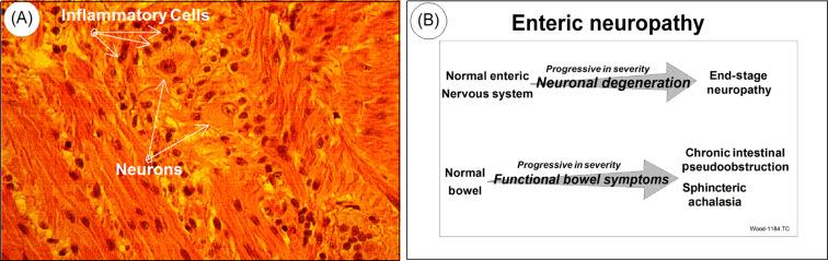 Fig. 67.1, Enteric neuropathy. (A) Idiopathic myenteric ganglionitis. Histological section of a ganglion in the myenteric plexus obtained from a full-thickness small intestinal biopsy acquired during exploratory laparotomy for intestinal obstruction. A diagnosis of neuropathic small intestinal pseudoobstruction was made on a basis of neuronal degeneration associated with an inflammatory infiltrate localized to the patienťs myenteric plexus. The patient had a multiple year history of complaints suggestive of IBS. Histological section and patient history provided by Dr. Claudio Fiocchi, University Hospitals, Cleveland, Ohio. (B) Parallel progression of enteric neuronal degeneration and functional gastrointestinal disorders (e.g., IBS). Most individuals start postnatal life with a normal ENS and normally functioning bowel. Neuronal degeneration mediated by autoimmune attack directed to the enteric nervous system (e.g., paraneoplastic syndrome, Chagas disease, idiopathic forms) can progress to a stage where ENS function is lost. Functional bowel symptoms appear as neurons are lost from the ENS microcircuits required for integrated function of the whole organ. Chronic intestinal pseudoobstruction of the neuropathic form occurs when the loss of neurons progresses to a stage where the neuronal circuits for propulsive motility are no longer functional.