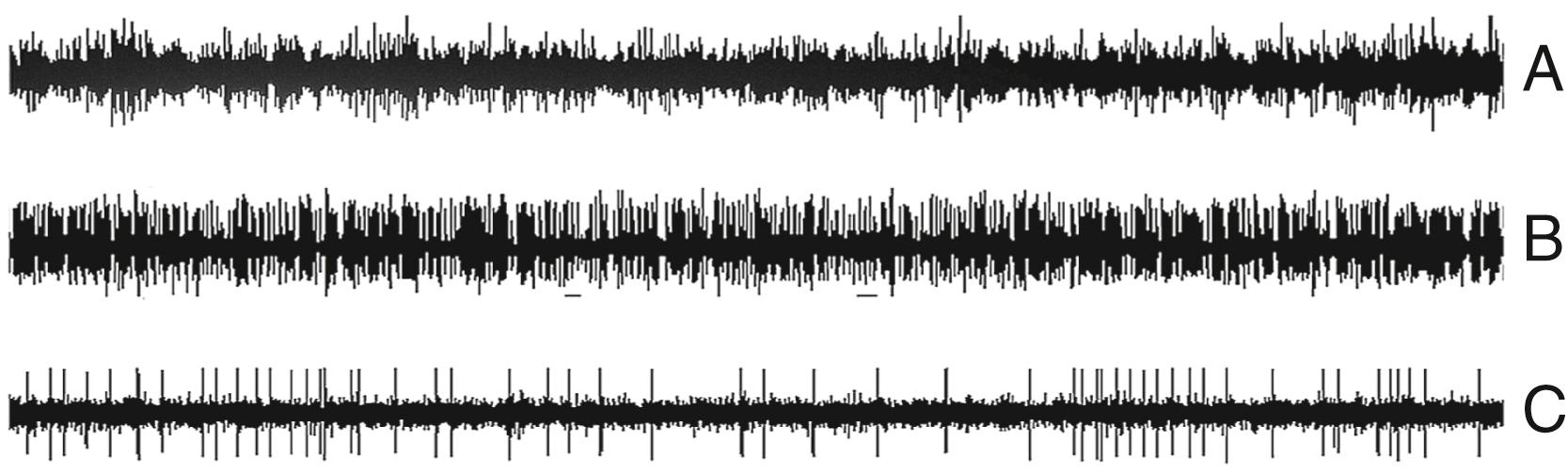 Figure 115.2, Examples of responses from three different types of recording electrodes.