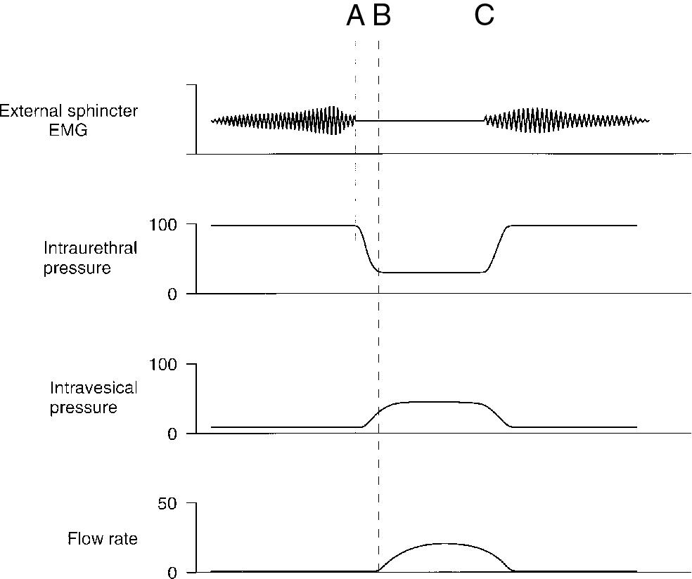 Fig. 3.3, Urodynamic representation of normal female micturition. A , Voluntary initiation of voiding with relaxation of external urethral sphincter and pelvic floor muscles and associated decrease in urethral pressure. B , Detrusor contraction occurs with increase in intravesical pressure; intraurethral pressure equals intravesical pressure, and urine flow is initiated. C , Voluntary termination of voiding. EMG, electromyography.