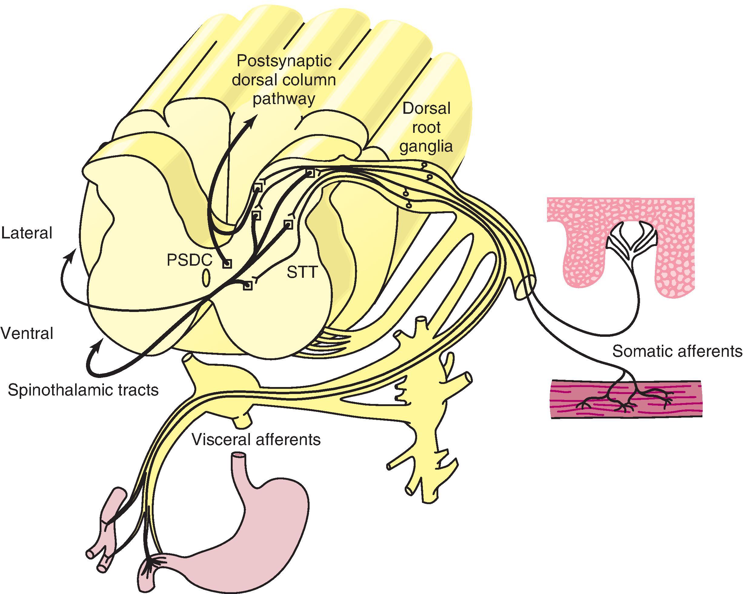 Figure 8.3, Nociceptive afferent nerve fibers have receptive free nerve endings in the dermal papillae of the skin and in the muscle, vasculature, and visceral structures. Nerves carrying nociceptive information travel with other somatic and autonomic motor axons, even passing through the autonomic ganglia, but have their cell bodies in the dorsal root ganglia located in the spinal vertebral column. The central axonal projection of afferent nerve fibers then passes through the dorsal root to innervate the spinal cord dorsal horn. Nociceptive information is relayed across at least one synapse in the dorsal horn to alert cells with projections to higher centers. The spinothalamic tract ( STT ) cells in the superficial dorsal horn send an axonal projection across the midline to travel in the lateral STT. STT cells in the deep dorsal horn send axons across the midline to ascend in the ventral white matter. STT cells bring information about both somatic and visceral pain to the thalamic levels. Post-synaptic dorsal column ( PSDC ) cells relay information about visceral pain through the ipsilateral dorsal column.