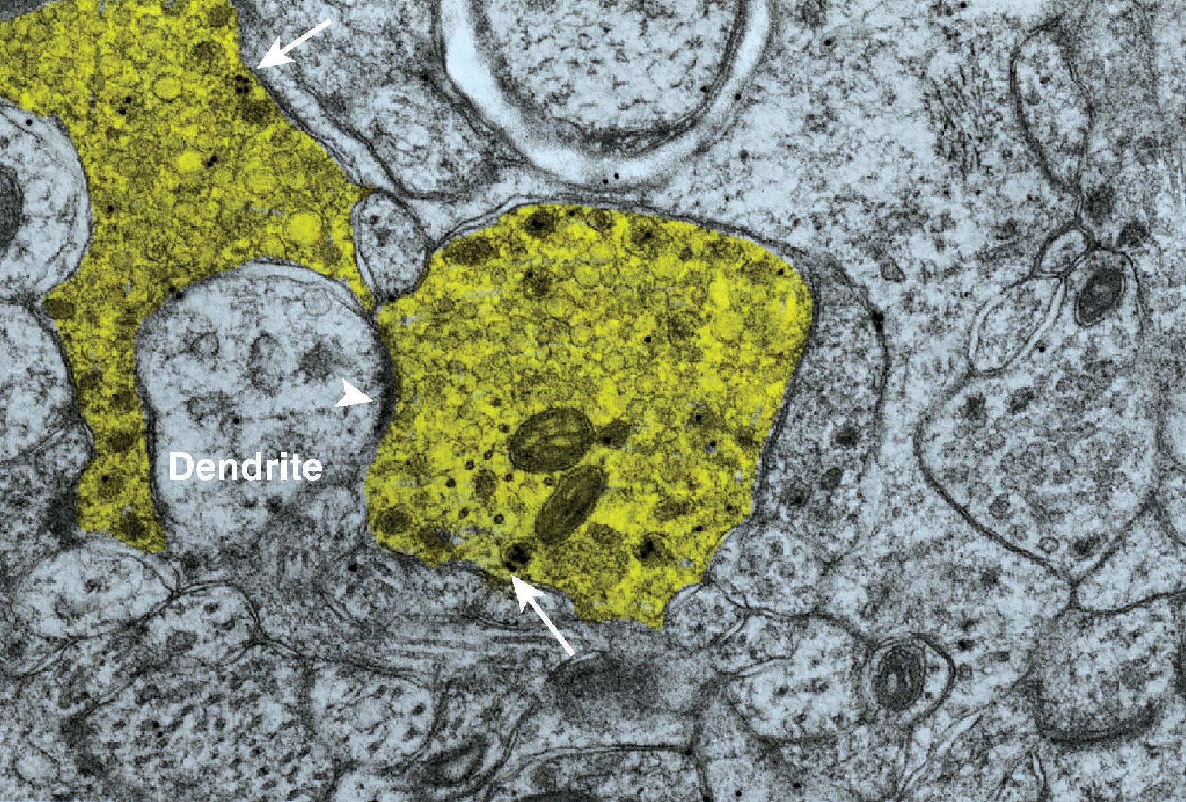 Figure 8.6, Many afferent nerve terminals in the spinal cord dorsal horn terminate in irregular, scalloped endings filled with both clear and dense core vesicles containing neurotransmitter substances. The scalloped endings ( colored yellow ) are formed as the endings contact numerous small dendrites of spinal neurons, such as the one shown containing the arrowhead. The arrowhead is directed toward a synaptic contact. Several of the dense core vesicles illustrated ( arrows ) in the terminal endings contain dense gold particles indicating immunolocalization of calcitonin gene-related peptide.