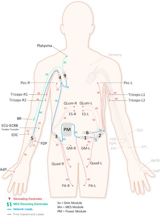 Figure 41.1, Anteroposterior projection schematic diagram of subject with networked neuroprosthesis (NNP) on right arm and implantable receiver stimulator (IRS-8; Freehand) generation hand function systems (Left hand). The NNP adds more modules and electrodes, which increases functional opportunities by controlling more muscle groups, uses internally sensed electromyography signals, and provides untethered power by an implanted power source. The devices and associated voluntary and paralyzed muscle transfers provide bilateral hand control, reach, trunk control, and sitting posture. (See radiograph, Fig. 41.2 ).