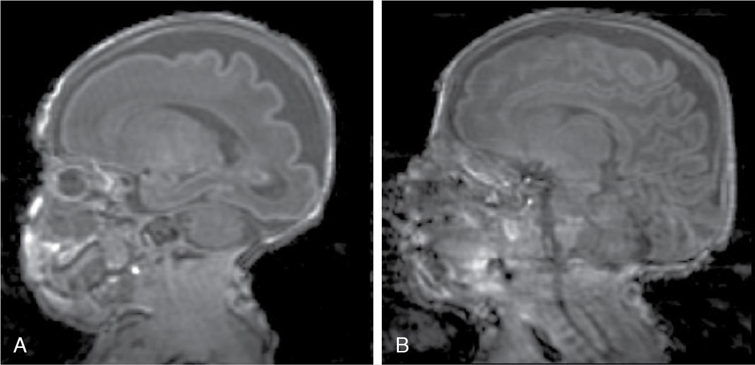 Figure 14.1, MRI images of a preterm infant born at 26 weeks gestation.