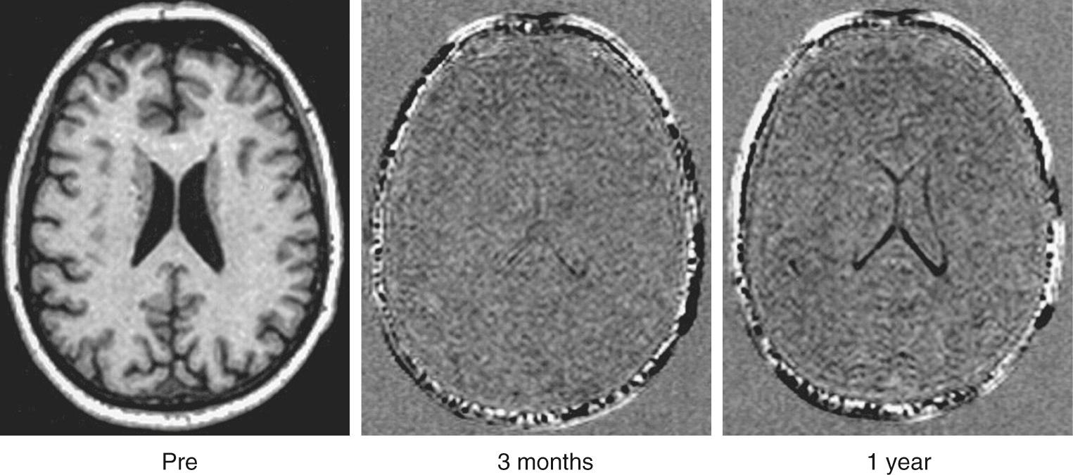 FIGURE 62-1, Preoperative brain MRI from patient undergoing extensive cardiac surgery superimposed on identical images taken at 3 months and 1 year after surgery. The appearance of the ventricles at 1 year indicates brain shrinkage, presumably from apoptosis of neurons.