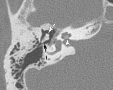 Fig. 4.1, Normal temporal bone anatomy, 0.3-mm axial CT. High-resolution CT of the right temporal bone at the level of the internal auditory canal displays exquisitely detailed anatomy, including the modiolus of the cochlea (arrowhead), malleus (short arrow), and incus (long arrow). High-resolution CT is excellent for the bony anatomy of the temporal bone. Note that the cerebellum and right temporal lobe soft tissue detail is quite poor using the bone algorithm.