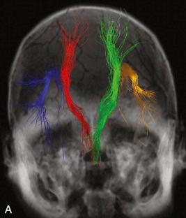 Fig. 4.11, Tractography. Three-dimensional (3-D) modeling technique that uses diffusion tensor imaging to visualize white matter tracts. (A) The 3-D image may be rotated to optimally visualize white matter tracts such as these normal corticospinal tracts and arcuate fasciculi. Tractography is useful in surgical planning to determine the relationship between white matter tracts and intracranial pathology. (B) 3-D tractography image reveals obliteration of the superior right corticospinal tract fibers due to vasogenic edema surrounding a right frontal lobe oligodendroglioma in a 34-year-old man who presented with seizures. The arcuate fasciculus is normal bilaterally. (C) Two-dimensional (2-D) unenhanced T1-weighted MR image with superimposed tractography reveals medial displacement of the right corticospinal tract by a right temporal lobe glioma in a 34-year-old man who presented with seizures.