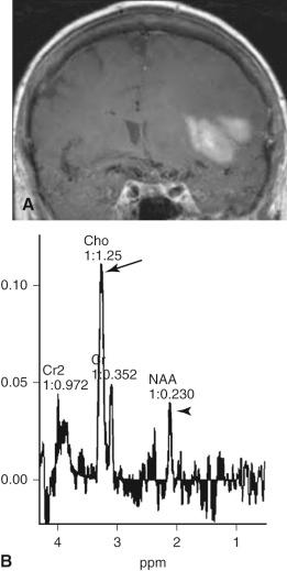 Fig. 4.12, Glioblastoma. Elderly man with a left frontal glioblastoma. (A) Enhanced coronal T1-weighted MR image demonstrates a hyperintense left frontal lobe mass. (B) Corresponding spectroscopy reveals an elevated choline (Cho) peak (arrow) and a depressed N -acetyl-aspartate peak (NAA) (arrowhead) suggesting a neoplasm.