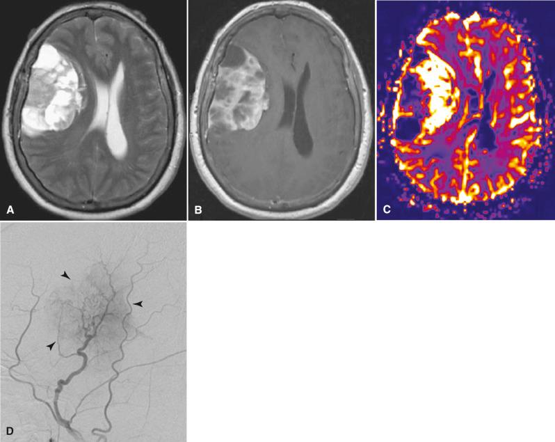 Fig. 4.14, Meningioma. Fifty-one-year-old woman with a right convexity meningioma. (A) T2-weighted axial MR image shows a heterogeneously hyperintense extra-axial right convexity mass, which partially effaces the right lateral ventricle and displaces the midline structures to the left. (B) The mass heterogeneously enhances following the administration of intravenous contrast. (C) Map of relative cerebral blood volume reveals markedly increased perfusion of the mass. (D) Selective right external carotid artery catheter angiogram demonstrates hypertrophied branches of the middle meningeal artery feeding the densely staining mass (arrowheads).