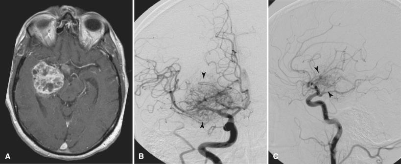 Fig. 4.16, Glioblastoma. Sixty-five-year-old man with progressive somnolence. (A) Enhanced T1-weighted axial MR image demonstrates a right temporal lobe-enhancing mass. (B) Frontal catheter angiographic projection and (C) lateral catheter angiogram projection of a right common carotid artery injection demonstrating an intense stain (arrowheads) fed by internal carotid artery branches corresponding to the right temporal lobe tumor identified on MR imaging.