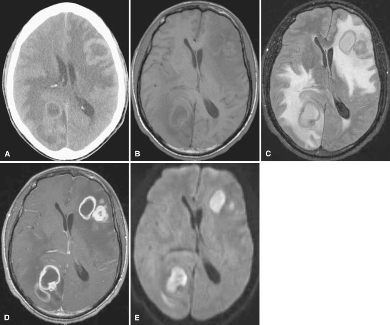 Fig. 4.4, Tuberculous abscesses. Forty-five-year-old man with acquired immunodeficiency syndrome, pulmonary Mycobacterium kansasii, and brain abscesses that responded to antituberculous medication. (A) Axial unenhanced CT image shows multiple ring-configured lesions surrounded by hypodense vasogenic edema. Mass effect effaces the right occipital horn and partially effaces the left frontal horn. (B) Unenhanced T1-weighted MR image demonstrates hypointense bilateral masses with surrounding edema corresponding to the CT image. (C) Axial T2-weighted fluid attenuated inversion recovery (FLAIR) image demonstrates hyperintense vasogenic edema surrounding the ring-configured masses. (D) Following administration of intravenous contrast, the enhanced T1-weighted axial MR image reveals multiple ring-configured lesions. The differential diagnosis would include metastases or abscesses. (E) Diffusion-weighted images reveal hyperintense central portions of the lesions suggesting abscesses rather than necrotic tumors. Note that the enhanced T1-weighted image greatly increases conspicuousness of lesions compared with the unenhanced T1-weighted image and that the FLAIR sequence optimally demonstrates the edema.