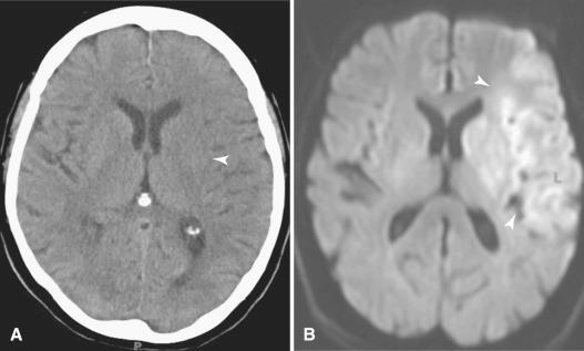 Fig. 4.5, Cerebral infarction. Eighty-year-old woman presenting with right hemiparesis. (A) CT scan demonstrates subtle left hemisphere cytotoxic edema manifested by loss of definition of the lateral margin of the basal ganglia (arrowhead) and relative effacement of the left cerebral sulci. (B) Diffusion-weighted MR scan demonstrating hyperintensity in the distribution of the left middle cerebral artery (arrowheads) confirms the presence of a subacute left cerebral infarct. CT may not differentiate soft tissues in the early phase of infarction. MR scanning is more sensitive than CT to subtle changes caused by edema.