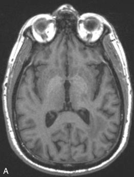 Fig. 4.8, Gadolinium deposition. Fifty-seven-year-old man with glioblastoma status post gross total resection and adjuvant chemoradiotherapy, now on active surveillance requiring numerous contrast-enhanced MR examinations. (A) T1-weighted axial MR image demonstrates hyperintense signal in the globus pallidi due to gadolinium deposition. (B) T1-weighted axial MR image through the cerebellum reveals T1 hyperintensity in the dentate nuclei due to gadolinium deposition.