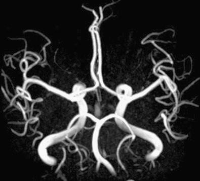 Fig. 4.9, MR angiogram. MR can be used to noninvasively generate images of the vascular tree, such as the circle of Willis in this study.