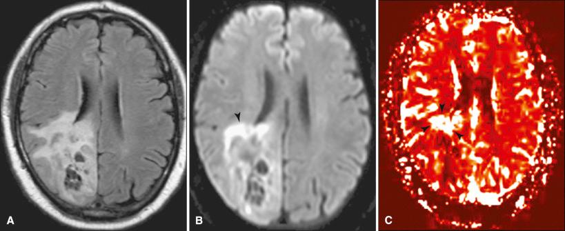 Fig. 4.10, Oligodendroglioma. Fifty-nine-year-old man with oligodendroglioma. (A) FLAIR MR image demonstrates a heterogeneously hyperintense intra-axial predominantly right occipital lobe mass. (B) Corresponding diffusion-weighted image reveals heterogeneous hyperintensity within the tumor bed, indicating cell packing. The anterior portion of the tumor is especially hyperintense (arrowhead), suggesting active proliferation of cells. (C) A relative cerebral blood volume map demonstrates hyperperfusion in the anterior portion of the mass (arrowheads) corresponding to the area of restricted diffusion. Caution in interpreting diffusion and perfusion data in oligodendrogliomas is warranted in that low-grade tumors may display striking abnormalities reminiscent of high-grade lesions.