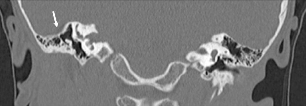 Fig. 135.2, Coronal computed tomography with the down-sloping lateral tegmen characteristic in a child with congenital aural atresia (arrow) . There is normal middle ear anatomy.