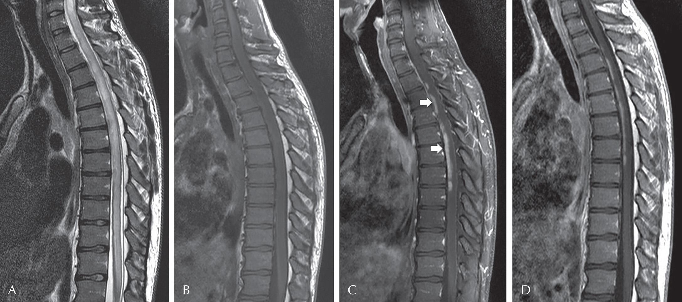 Fig. 47.1, Imaging Findings of Neurosarcoidosis Affecting the Spinal Cord.