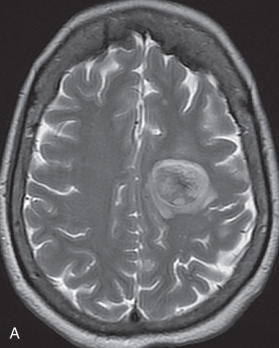Figure 14.5, Solitary parenchymal lesion in a patient with neurosarcoidosis.